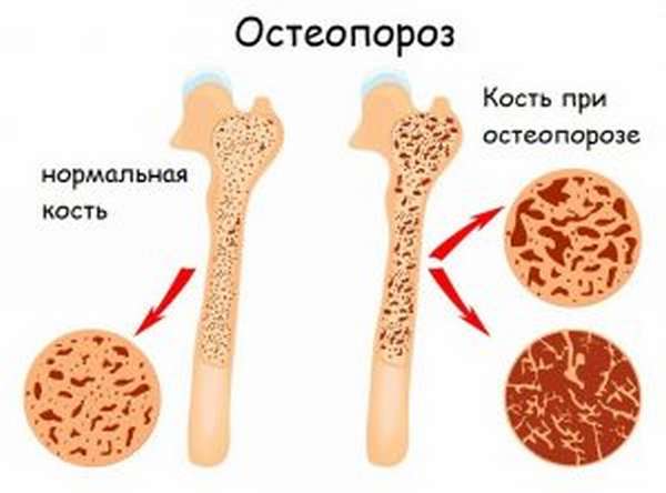 Остеосинтез кости плеча